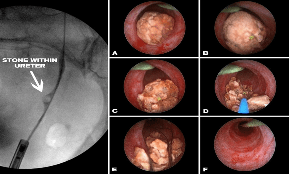 Endoscopy